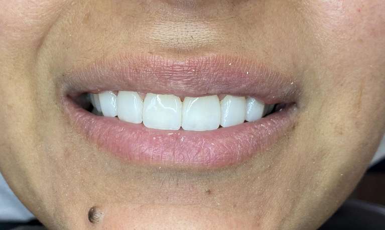 Anterior-Cosmetic-Crowns-After-Image