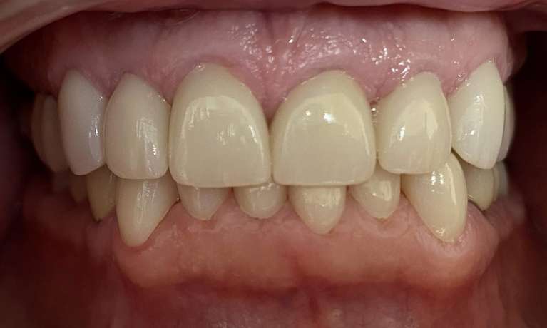 Anterior-Cosmetic-Crowns-After-Image
