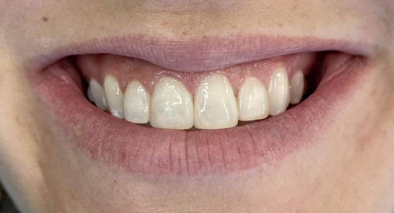 Cosmetic-Bonding-After-Image