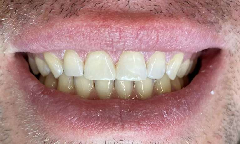 Cosmetic-Bonding-After-Image