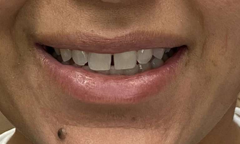 Anterior-Cosmetic-Crowns-Before-Image