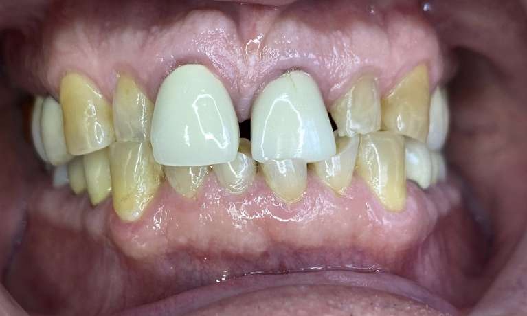 Anterior-Cosmetic-Crowns-Before-Image