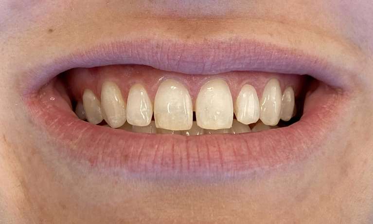 Cosmetic-Bonding-Before-Image