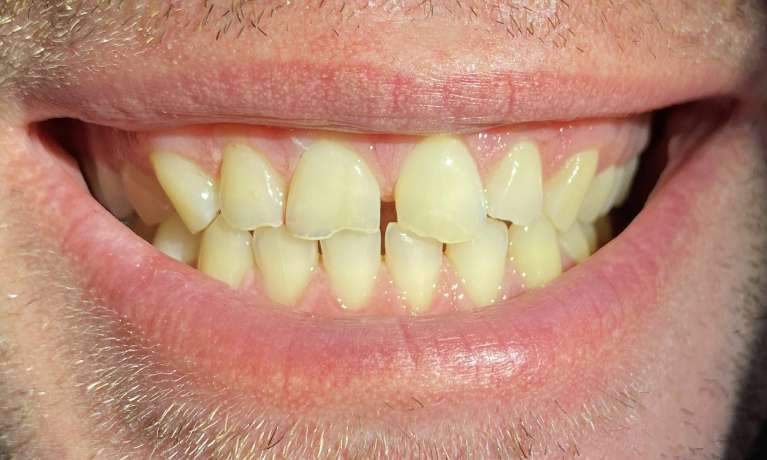 Cosmetic-Bonding-Before-Image